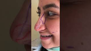 Ethnic Rhinoplasty [upl. by Abebi]