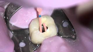 Obturating a TRUShape® case with Dr Gutmann [upl. by Huda]