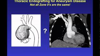 Endovascular Stent Grafting for ascending and aortic arch repair by John Ikonomidis MD Part 2mov [upl. by Zavras166]