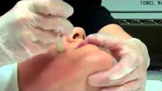 Dermapen Micro Needling Treatment [upl. by Waldemar424]