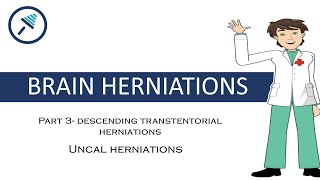 BRAIN HERNIATIONS 34  Uncal herniation [upl. by Amethyst120]