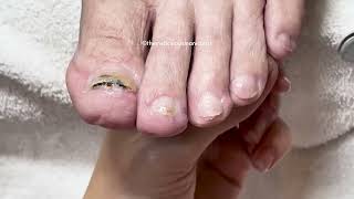 👣Pedicure for Men  Repair Damaged Toenails👣 [upl. by Ariew682]