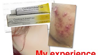 Contractubex gelbest gel for acne and scarsWith my acne pics must watch👍 [upl. by Ogdan]