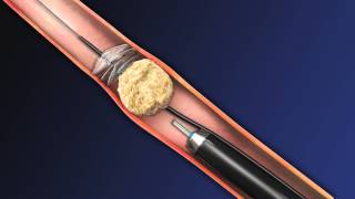 CoAx 10mm Stone Control Catheter from Accordion Medical [upl. by Bink]