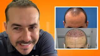 Transplante capilar 3 meses após o procedimento Hair transplant 3rd month [upl. by Aihppa]