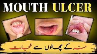 Mouth Ulcer  canker sore treatment  muh ky chalon ka ilaj [upl. by Naugal]