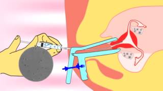 Intrauterine insemination IUI videoflv about infertility and ivf treatment [upl. by Nel]