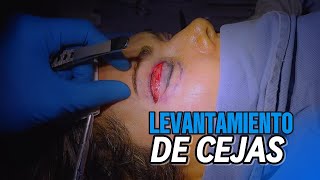 LEVANTAMIENTO de cejas CIRUGIA [upl. by Tufts]