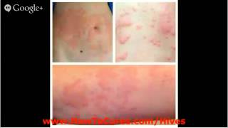 Urticaria Pictures  Protocols For Soothing Acute Urticaria  Urticaria Pictures [upl. by Dorey]