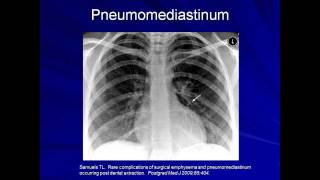 Lung Protective Ventilation Mechanical Ventilation  Lecture 9 [upl. by Noletta]