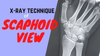 Technique of Scaphoid view Ep45  Xray scaphoid bone  procedure of Scaphoid views Tutorial [upl. by Alyakcim]