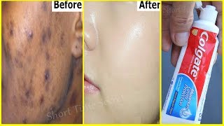 In 2 DAYSRemove DARK SPOTS With Toothpaste Apply Toothpaste on Your Darkspots and See the Magic [upl. by Daigle]