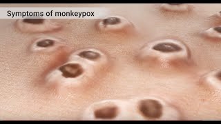 Why are people struggling to get a jab against monkeypox  ITV News [upl. by Ennaed]