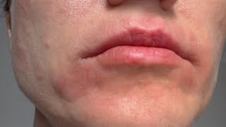 how to get rid of eczema on face at home [upl. by Keldon]