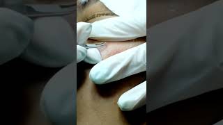 The Blackhead Extractions Breakthrough [upl. by Mastic335]