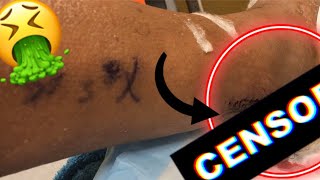 Achilles Tendon Rupture 2nd Post Op Visit WTF did I do to deserve this [upl. by Areip]