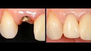 Ferrule Effect  A different point of view of the preparation of endodontically treated teeth [upl. by Aiciles]