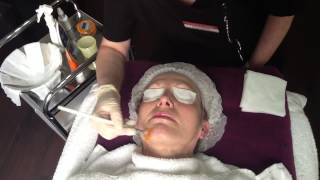 NeoStrata Glycolic Acid Skin Peel UK in Droitwich Clinic Worcestershire [upl. by Annerol624]