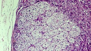 What is Hyperplasia  Pathology mini tutorial [upl. by Slin279]