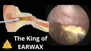 Ear wax ear wax removal ear wax removing how to clean ear wax at home 耳垢耳垢 ごっそり耳垢 ポコピー ขี้หู [upl. by Reyam182]