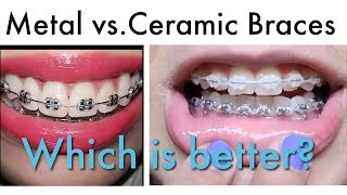 WHICH IS BETER Metal or Ceramic Braces [upl. by Farrison]