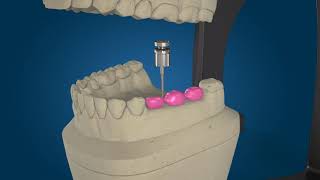 REHABILITACION CON PILARES CALCINABLES [upl. by Vance]