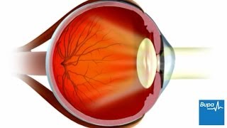 How LASIK eye surgery is carried out [upl. by Agnesse376]