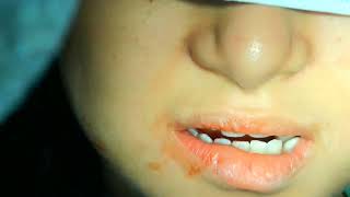 dentigerous cyst removal in mandible for a 13yr old girl  by drcmurugavel [upl. by Teik141]