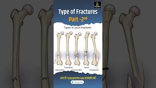 Common types of Bone fracture Part 2nd Types of Fracture facture bones shortvideo testpaperlive [upl. by Tarsuss123]