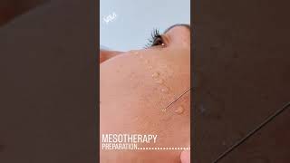 Mesotherapy Facial Treatment Benefits Procedure amp FAQ  EDEN AESTHETICS Dubai [upl. by Maryrose826]