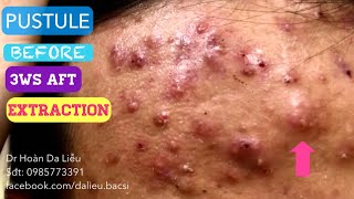 Mụn trứng cá trán cực nặngDermatologistpimplesblackheadanti acnepustule bef aft and extraction [upl. by Adiv]