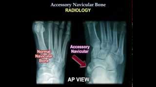 Accessory Navicular Bone  Everything You Need To Know  Dr Nabil Ebraheim [upl. by Gelhar630]