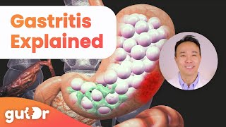 What is Gastritis  The GutDr Explains 3D Gut Animation [upl. by Nnyroc982]