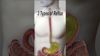 3 Types of Reflux GERD LPR nonacidic LPR shorts fauquierent [upl. by Mccomb]