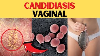 Candidiasis Vaginal Causas Y Como Tratarla 🤔 [upl. by Galvin]