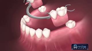 Removable denture Beirut Lebanon  Dentist Lebanon [upl. by Mahtal]