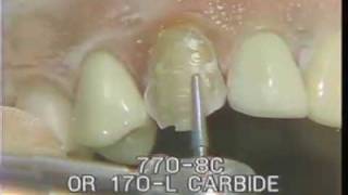 Maxillary Cuspid Preparation for a Porcelain Fused to Gold Crown [upl. by Toth]