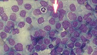 5 Minute Rounds Lymphoma [upl. by Elrebmik]