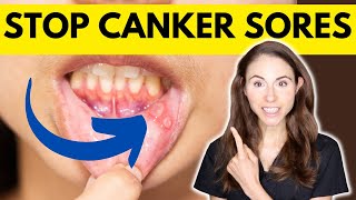 9 Tips To Prevent Canker Sores [upl. by Gnivre]