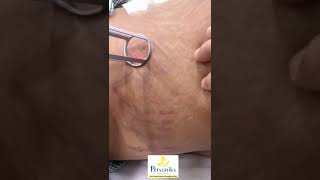 Laser Stretch Marks Removal Treatment In Hyderabad  Best Treatment For Stretch Marks  Hyderabad [upl. by Dorcas]