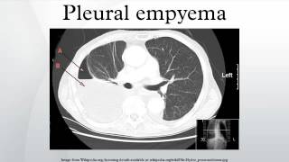 Pleural empyema [upl. by Dody]