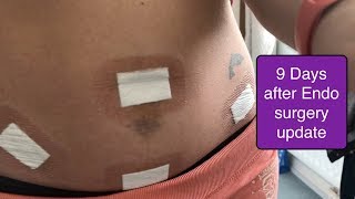 Laparoscopy Surgery for Endometriosis  9 Days After Jul 2018 [upl. by Mat]