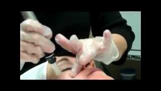 Dermapen Scottsdale AZ Practioner showing Micro Needling SkinPen Thearpy [upl. by Kravits]