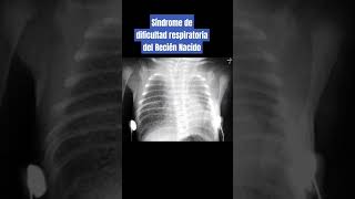 SÍNDROME DE DIFICULTAD RESPIRATORIA DEL RECIÉN NACIDO [upl. by Jerome]