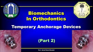 Biomechanics of TADs with Clinical Consideration Part 2 [upl. by Ednalrym]