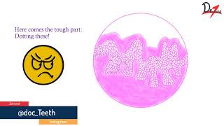 Verrucous carcinoma Histopathological features lets draw [upl. by Kosiur]