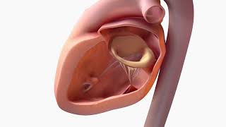 Secondary Mitral Valve Regurgitation [upl. by Buell]