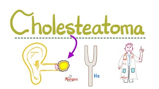 Hearing Loss Deafness  Cholesteatoma  Causes Symptoms Diagnosis amp Treatment  ENT  Pathology [upl. by Skye]