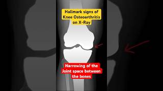 Joint space narrowing on Xray of knee with Osteoarthritis health radiology kneepain [upl. by Sissie]