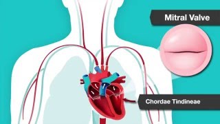 Understanding Heart Murmurs Aortic and Mitral Valve Problems [upl. by Litt]